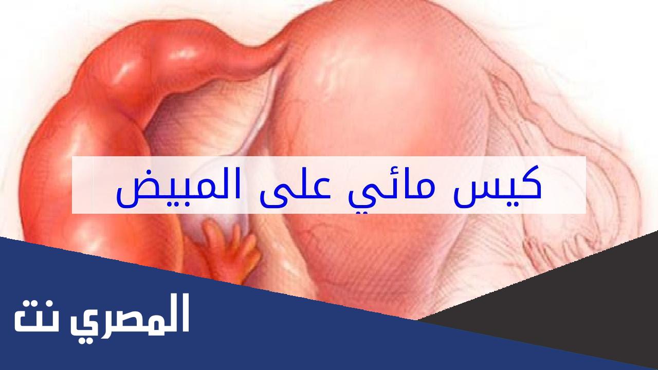 كيفية علاج كيس الماء على المبيض