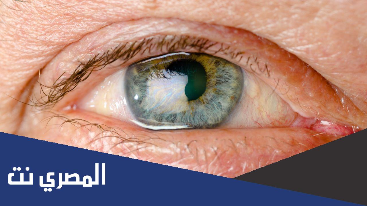 كيفية علاج مرض ويلسون