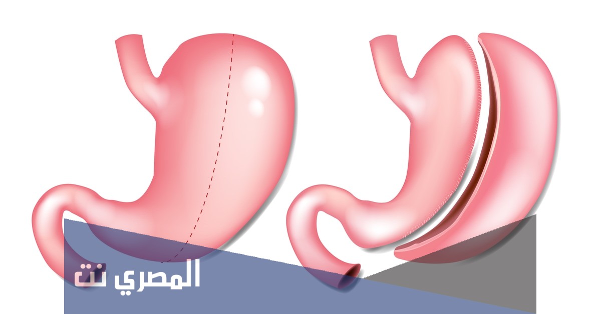 ما الفرق بين تكميم المعده وتدبيس المعده