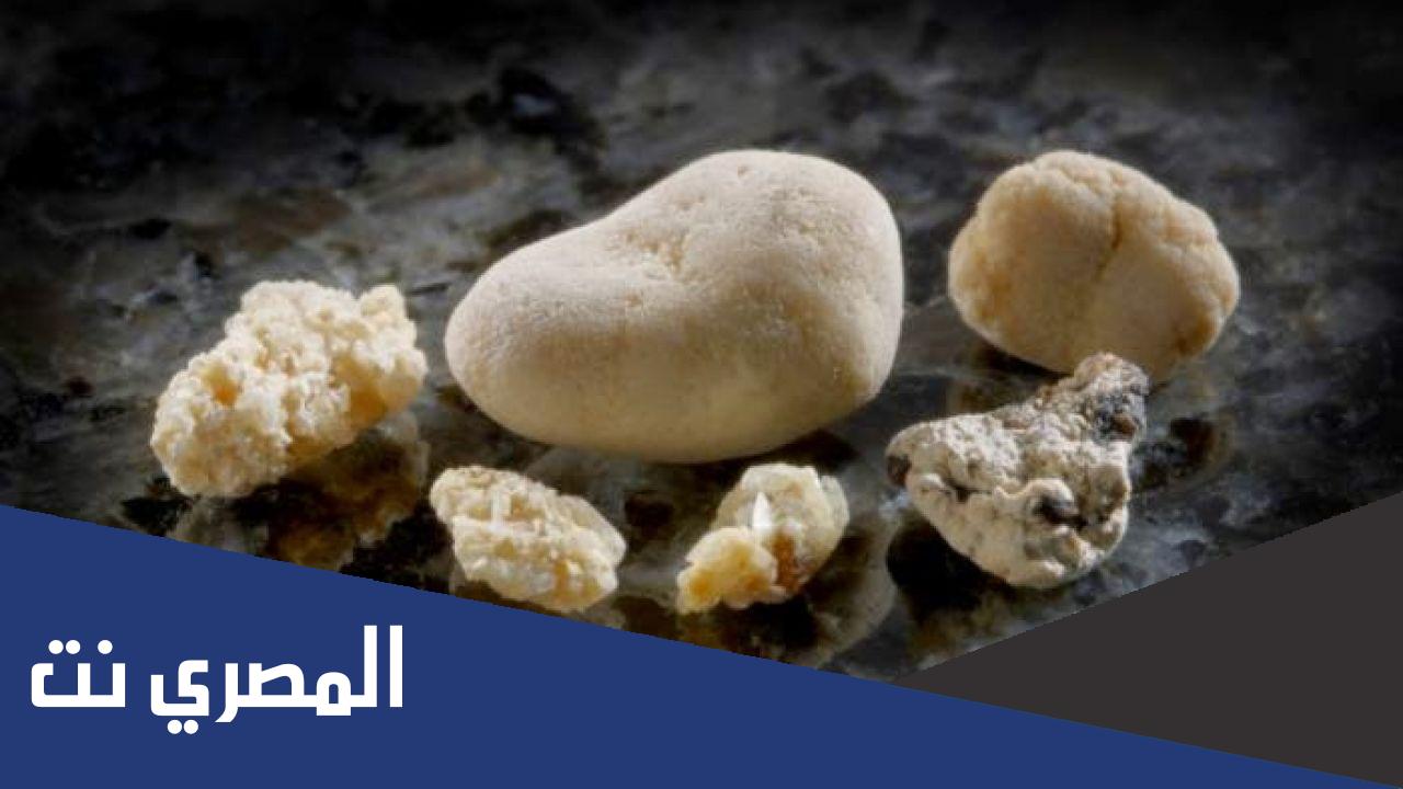 ما الفرق بين حصى المرارة وحصى الكلى ؟