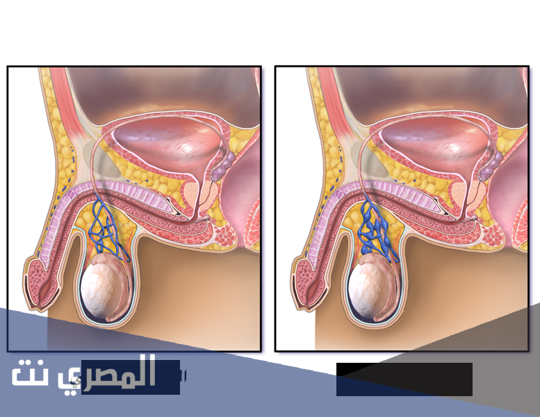 ما تأثير الدوالي على الخصيتين