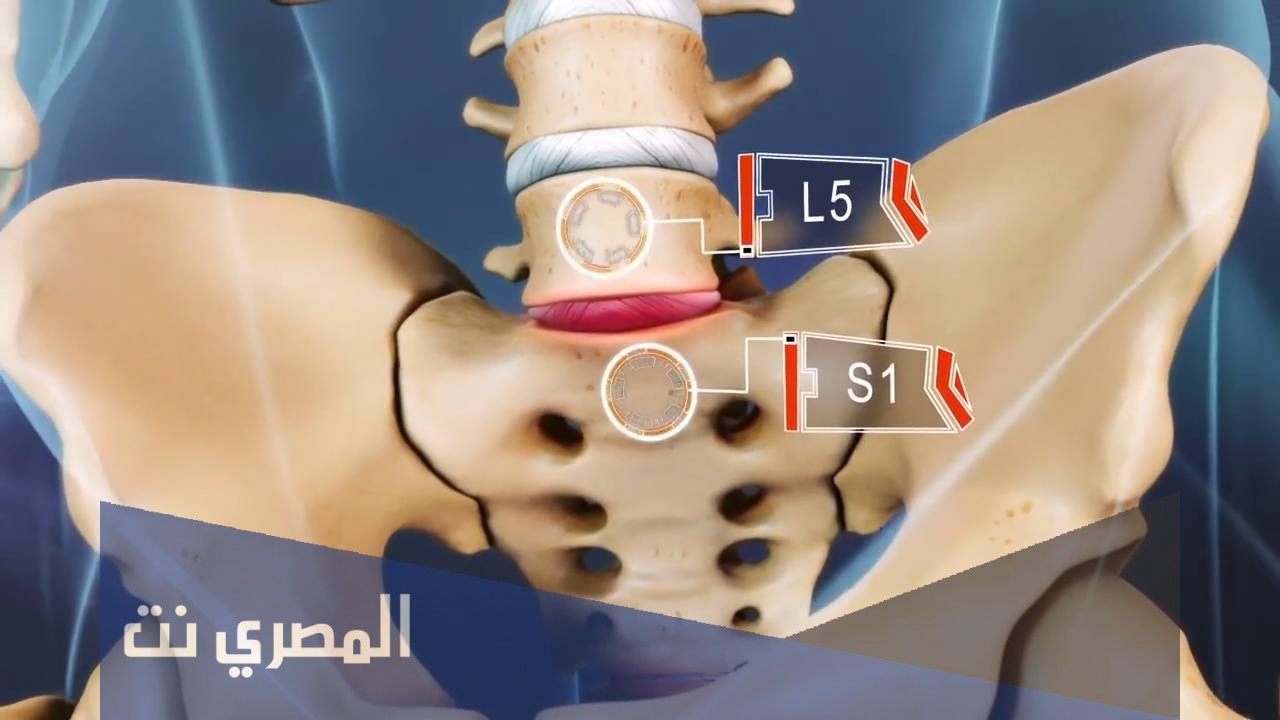 ما تأثير ضغط الفقرات القطنية على الأعصاب