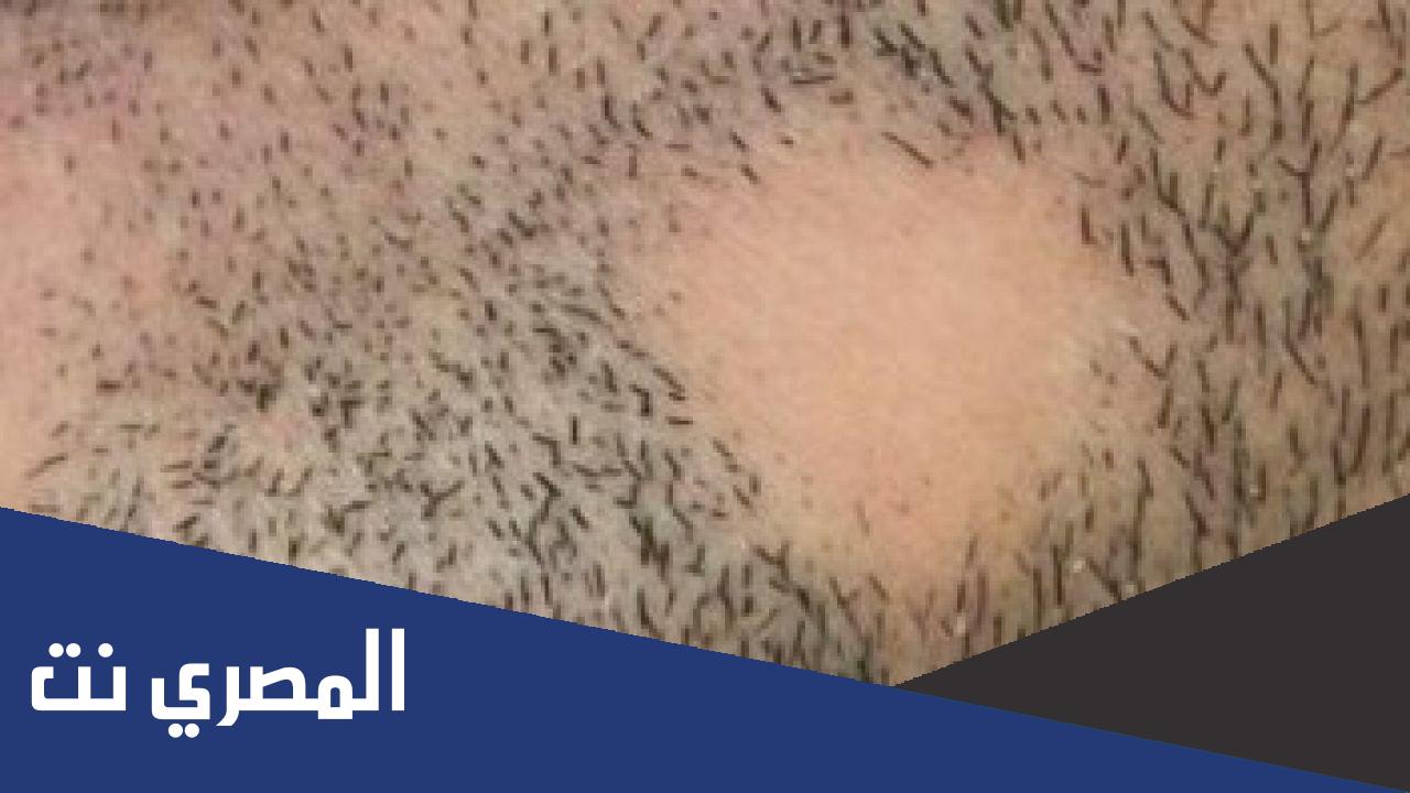 ما هو علاج الثعلبة في الذقن ؟