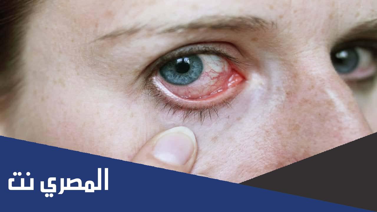 ما هو علاج حساسية العين