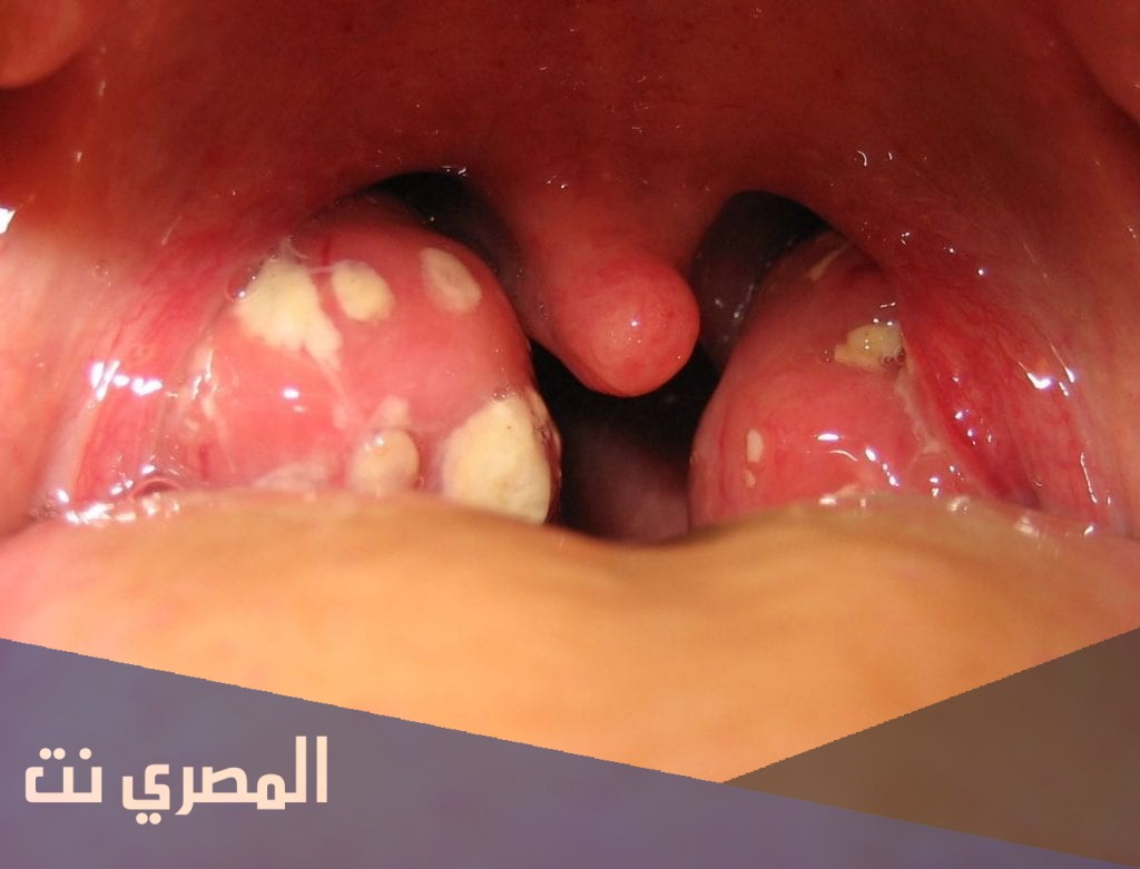 ما هو علاج صديد اللوز الشديد عند الاطفال