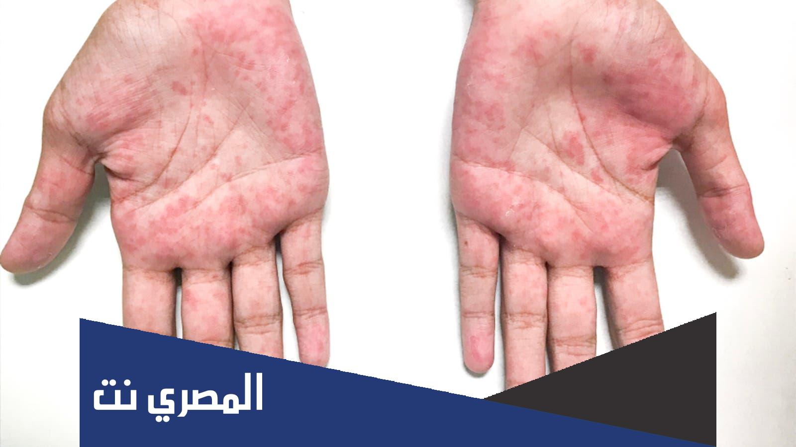 ما هو علاج مرض كاواساكي