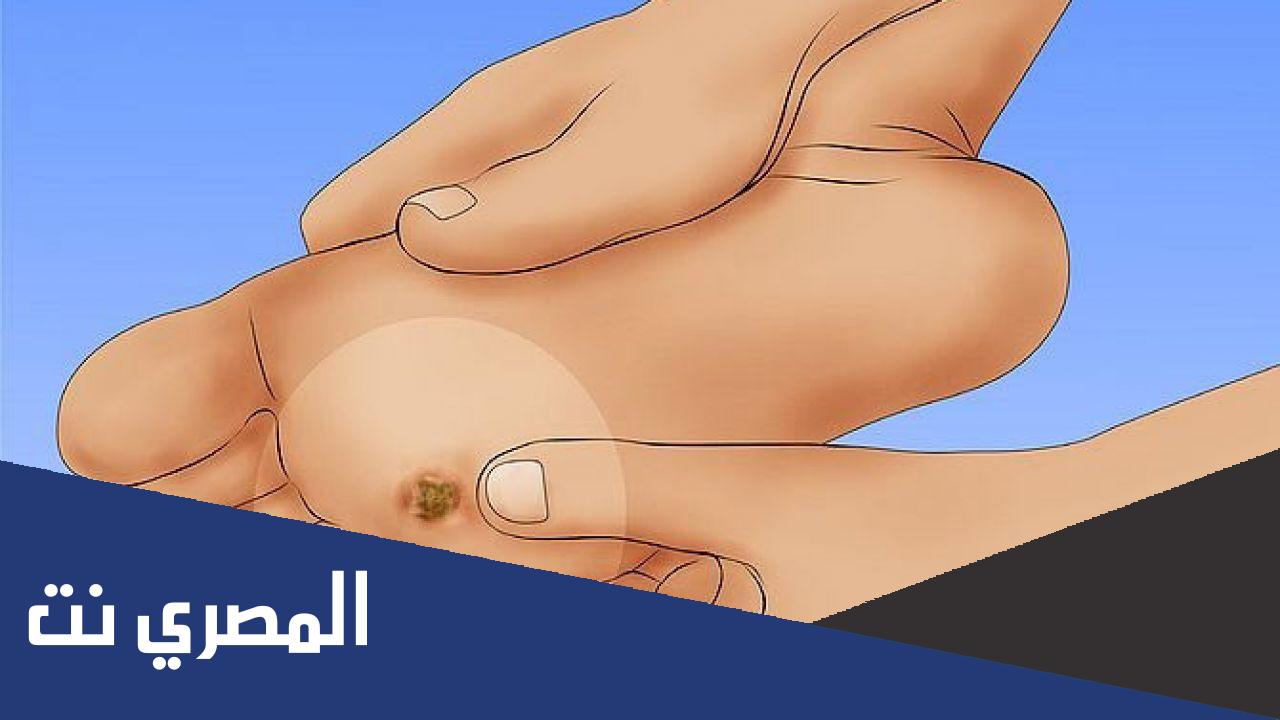 ما هو مسمار اللحم وعلاجه ؟