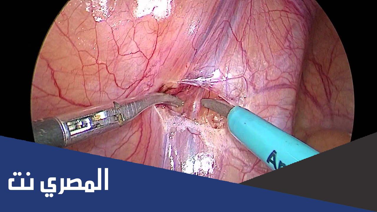 ما هى أسباب دوالى الخصيتين