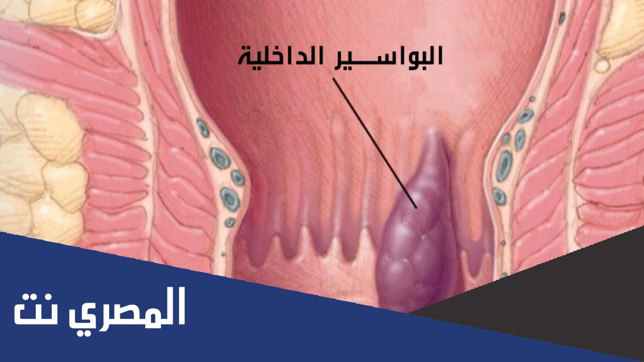 ما هي أسباب البواسير عند الرجال ؟