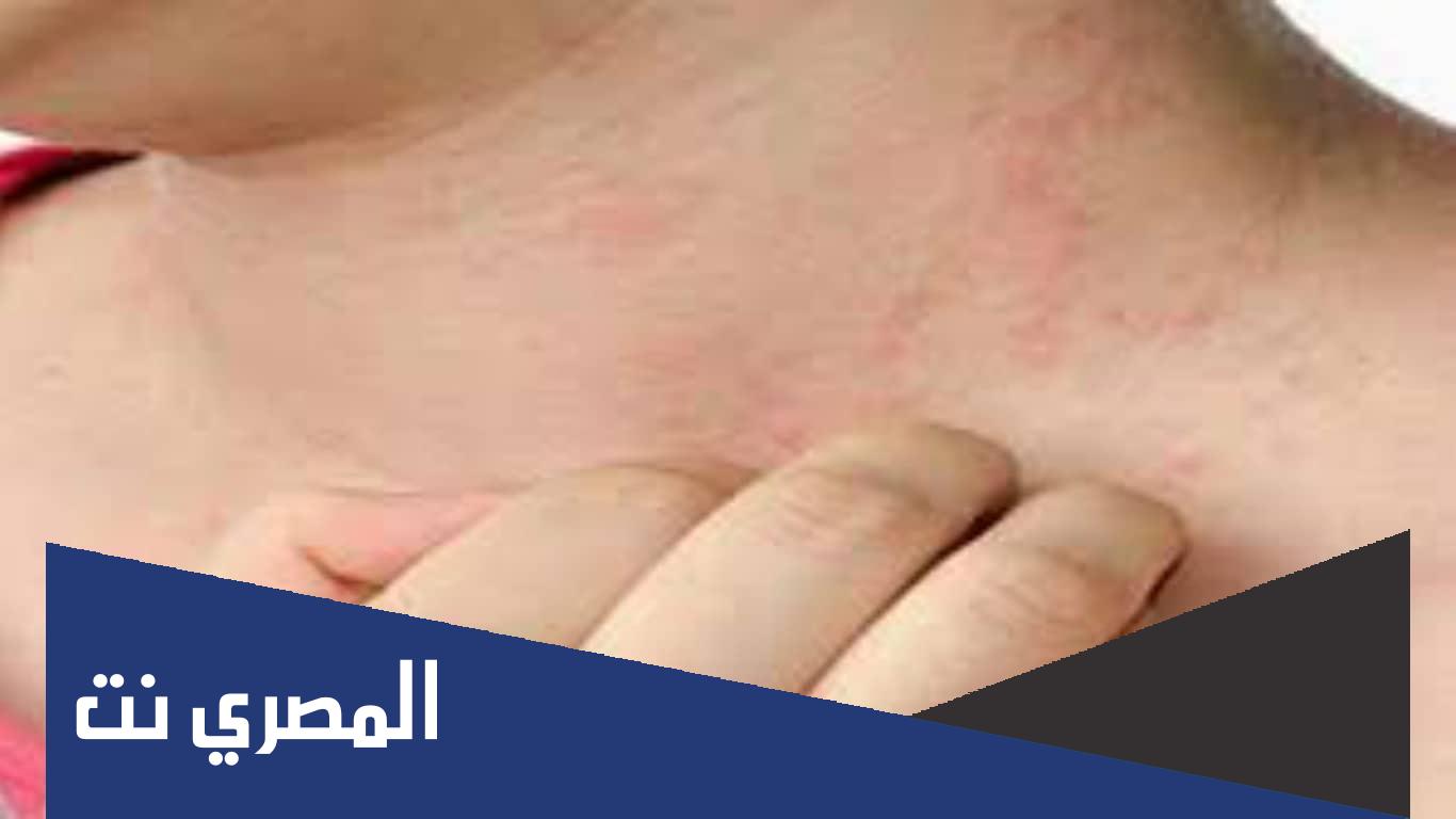ما هي أسباب حساسية الأرتكاريا