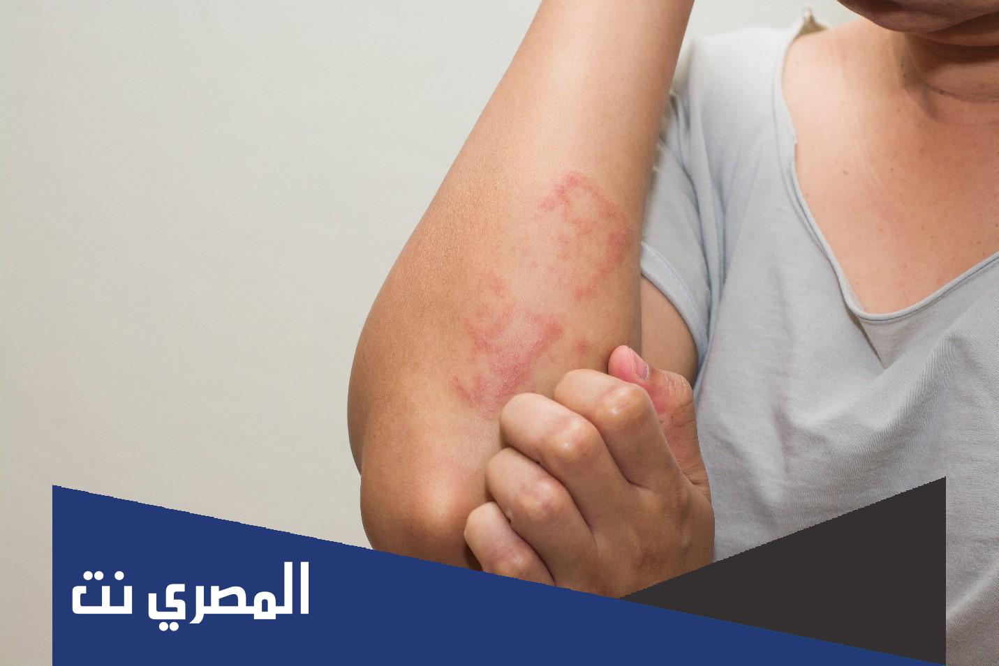 ما هي أعراض الحساسية