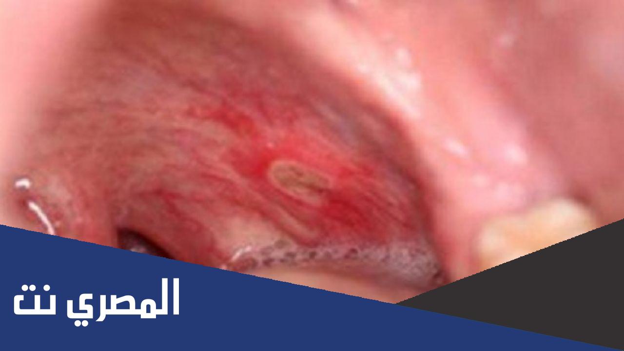 ما هي أعراض قرحة القولون