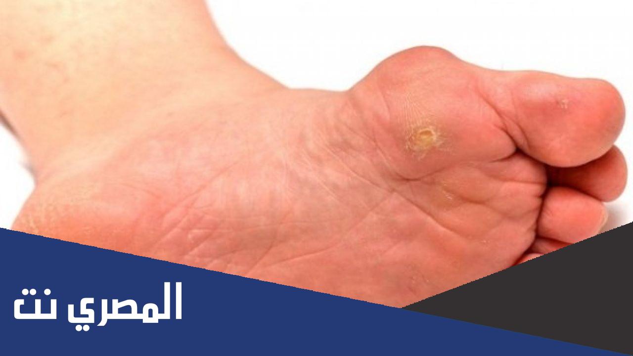 ما هي أعراض مسمار العظم ؟