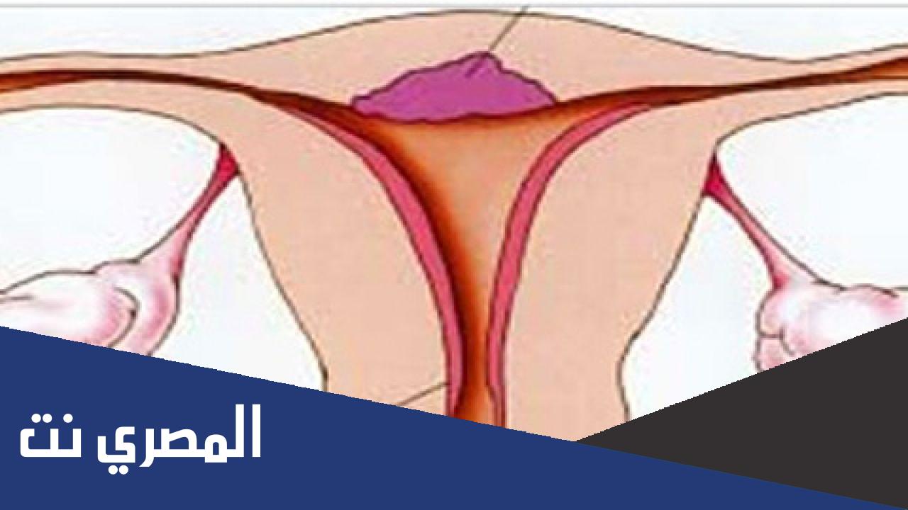 ما هي جرثومة عنق الرحم