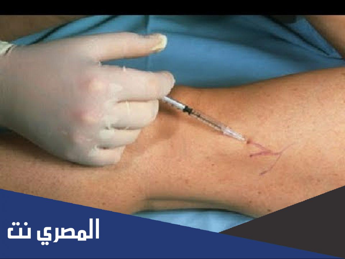 ما هي حقن التصليب لعلاج مرض الدوالي