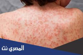 ما هي مضاعفات مرض كاوازاكي وتشخيصه