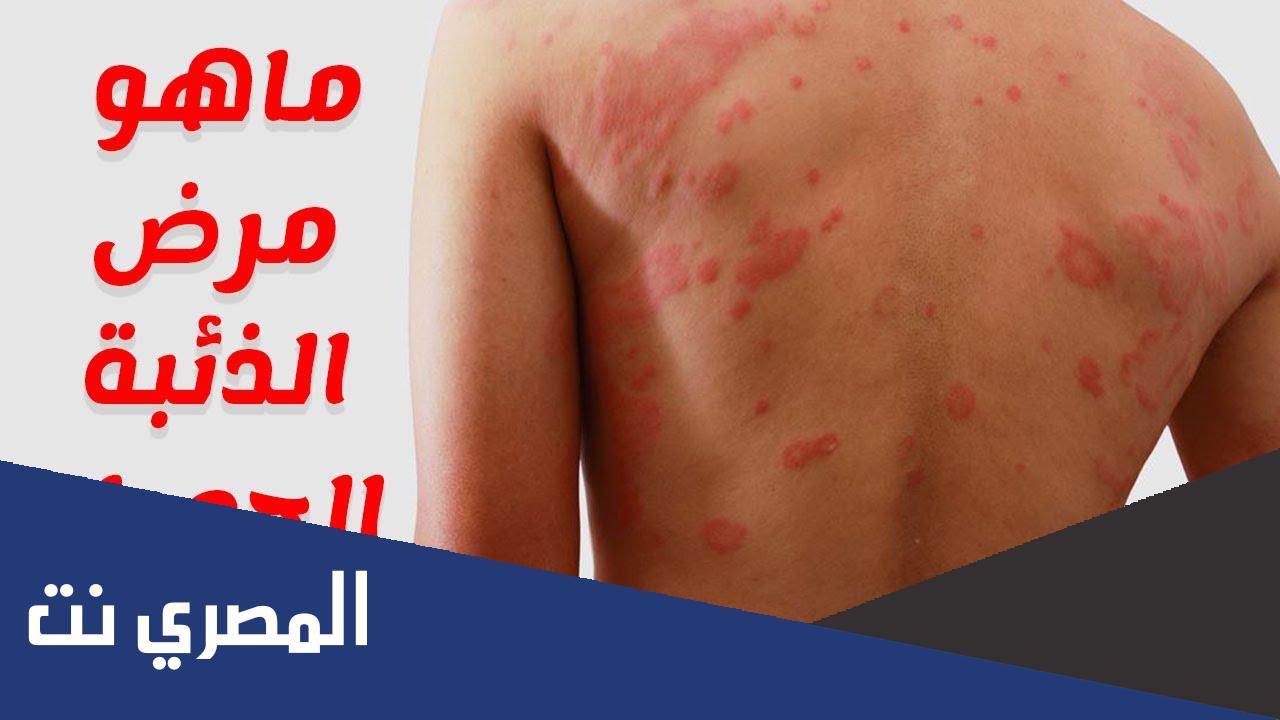 ما هي نصائح لمرضى الذئبة الحمراء ؟