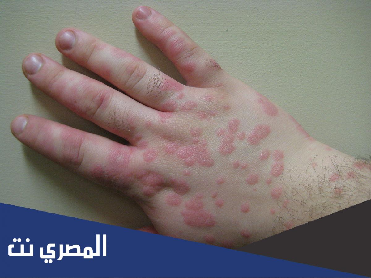 متلازمة ستيفن جونسون