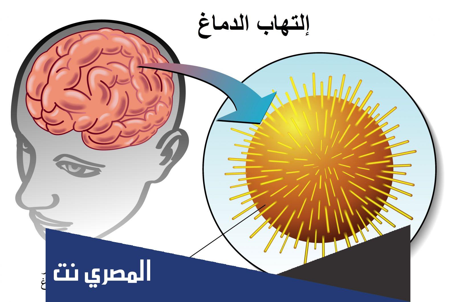 مرض التهاب الهربس الدماغي