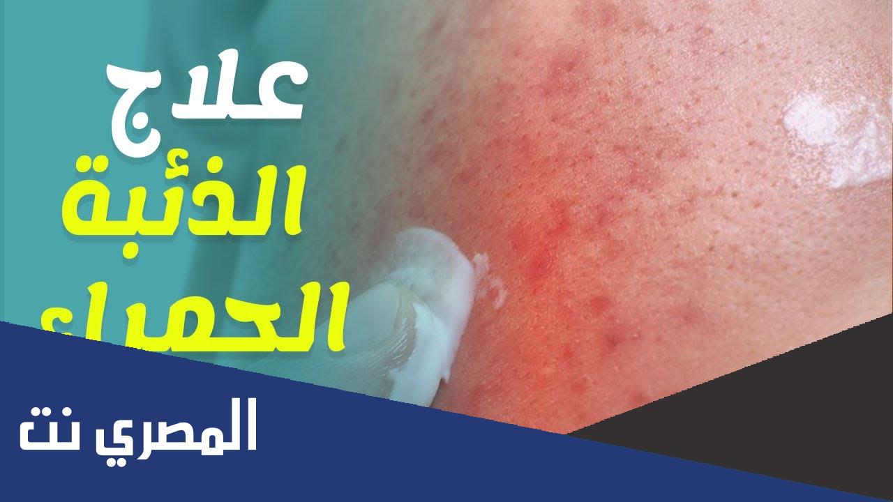مرض الزئبق الأحمر و اين يوجد ؟