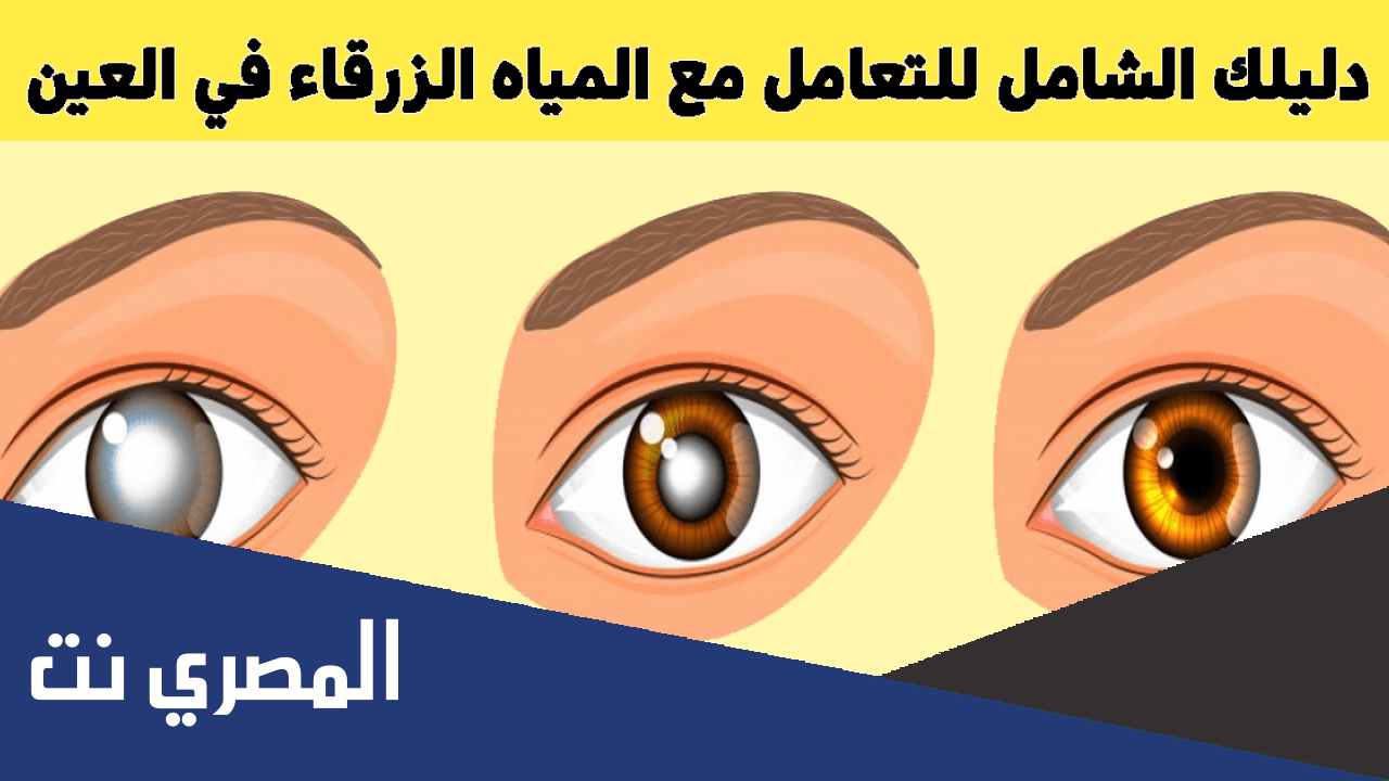 مرض المياه الزرقاء والبيضاء في العين