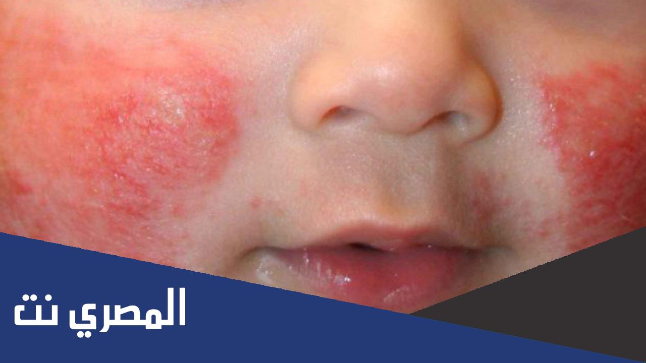 مرض حساسية القمح عند الأطفال