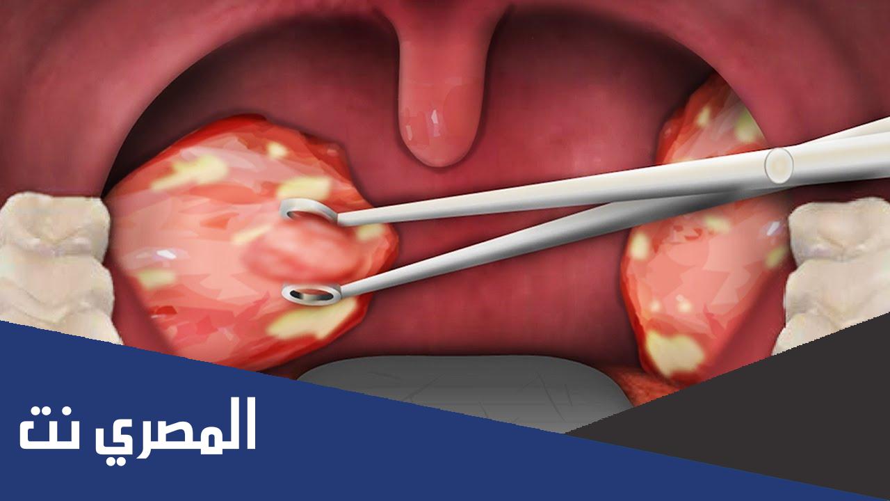 مضاعفات عملية اللوز واللحمية للاطفال وعلاجها