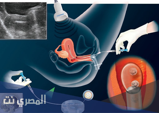 معلومات طبية عن الحقن المجهري