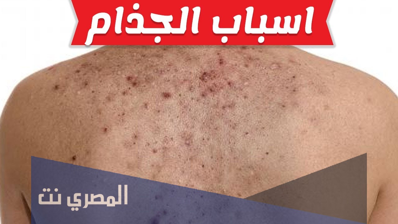 معلومات طبية عن مرض الجذام