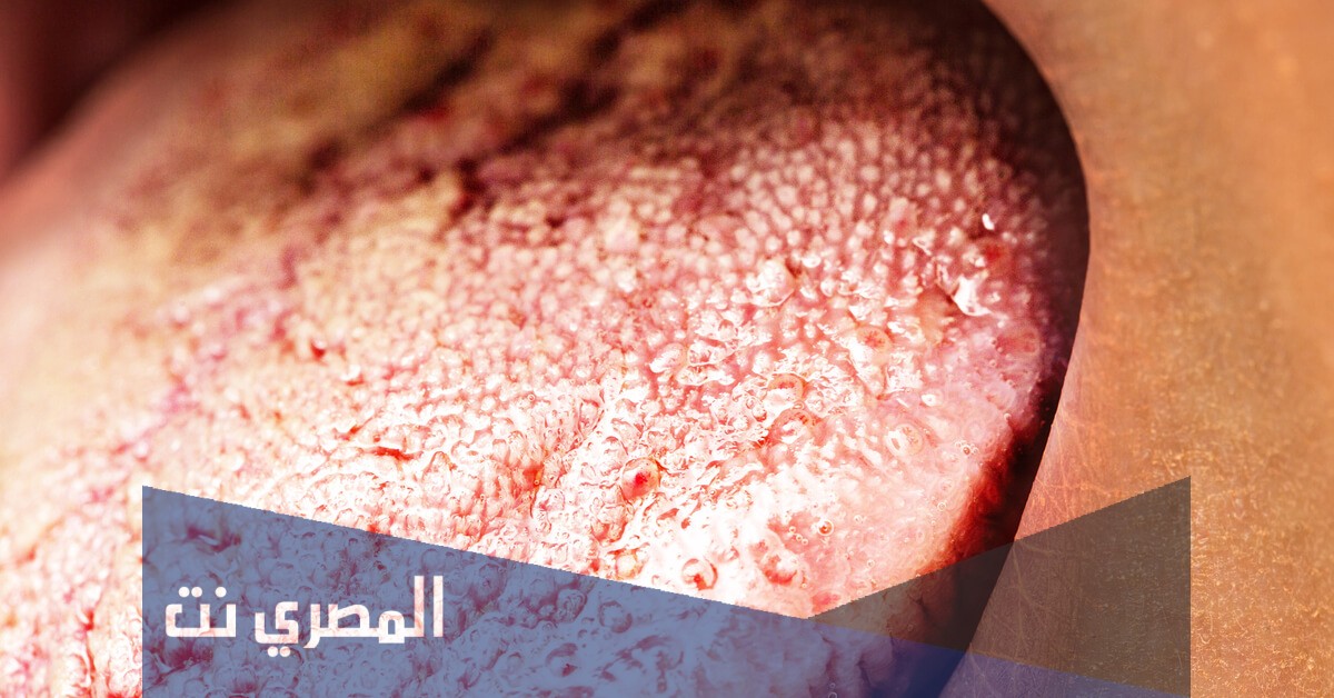 معلومات طبية عن مرض القلاع الفموي