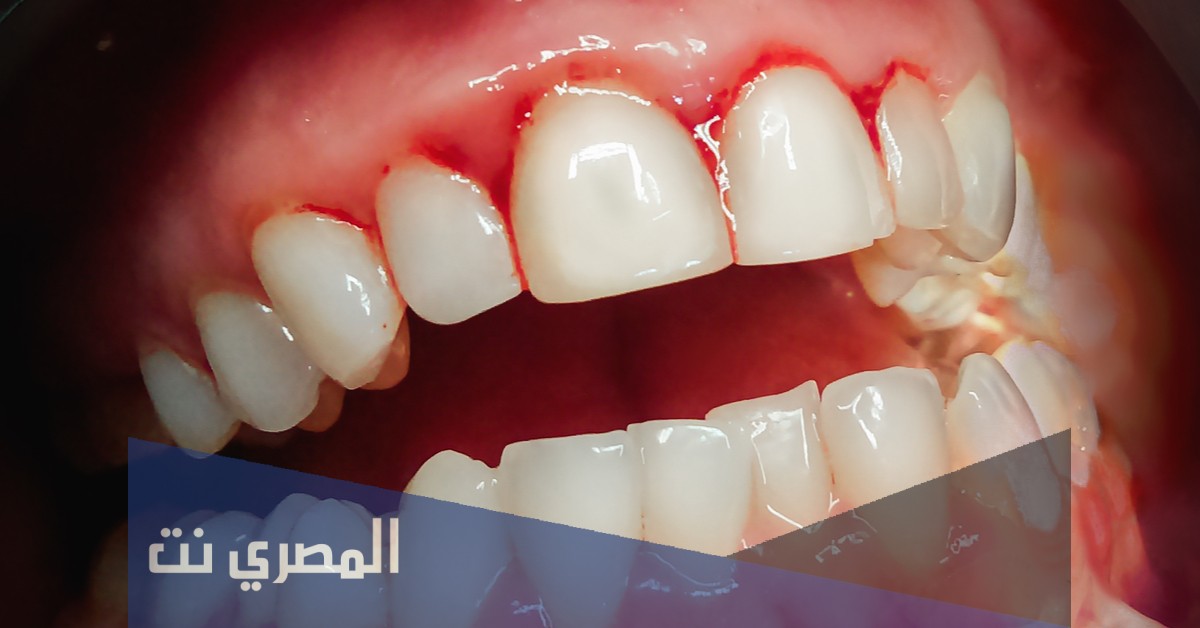 معلومات عن علاج نزيف اللثة