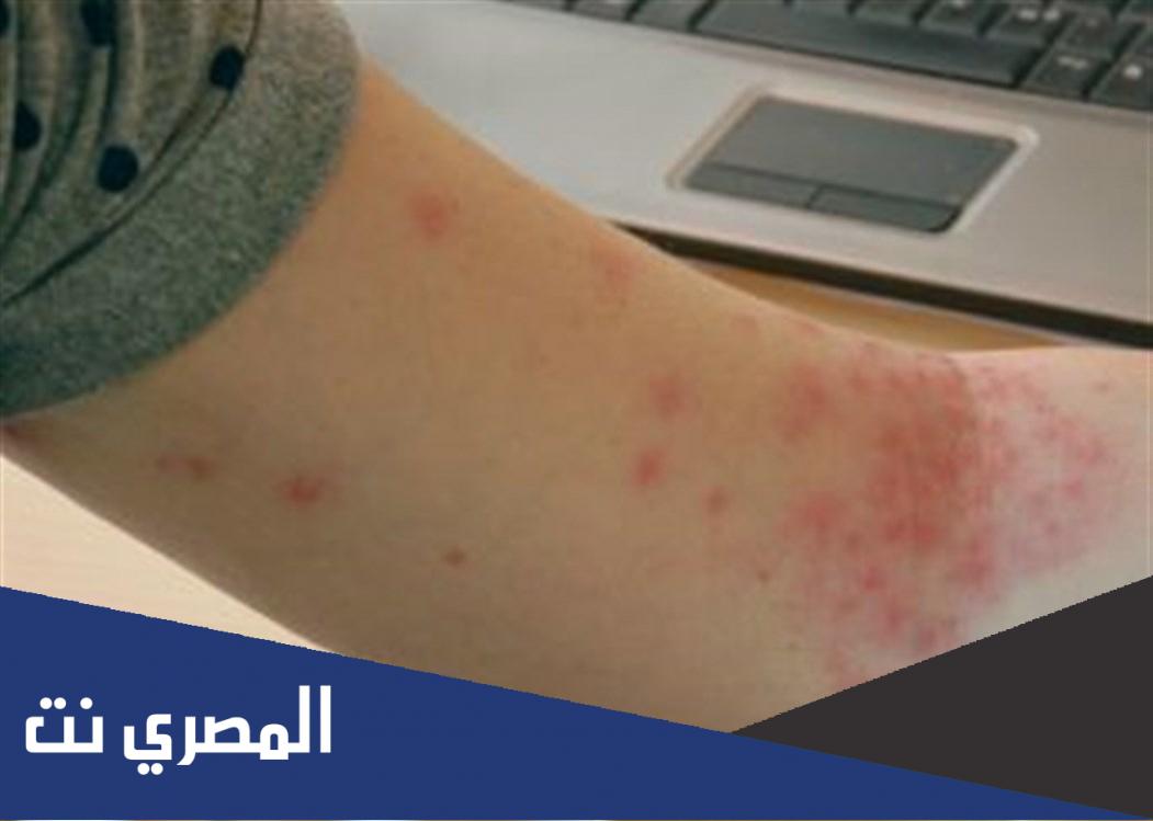 معلومات عن مرض الحساسية
