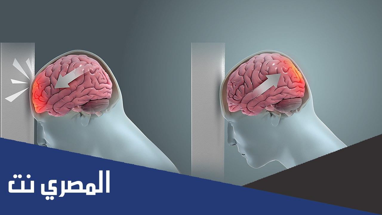 من أنواع إصابات الرأس