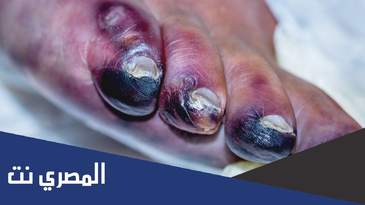 نصائح عن الغرغرينا