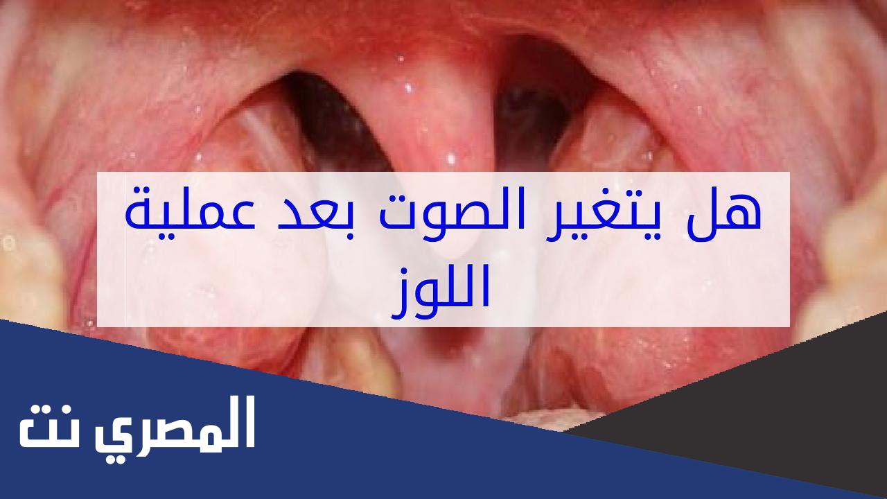 هل يتغير الصوت بعد عملية اللوزتين ؟