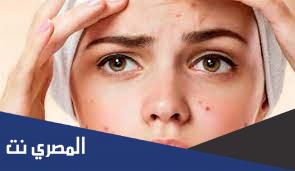 وصفات منزليه لعلاج حب الشباب