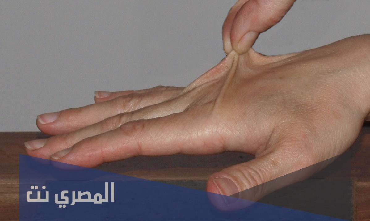متلازمة اهلرز دانلوس ويكيبيديا