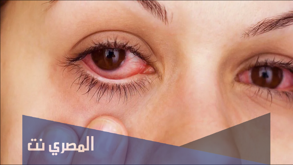 مرهم بوليسبيكتران Polyspectran لعلاج عدوي العين البكتيرية والميكروبية