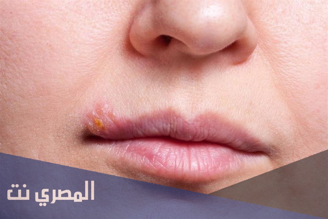 أقراص بروبينسيفير لعلاج عدوي الفم وهربس التناسلي وفعاليته