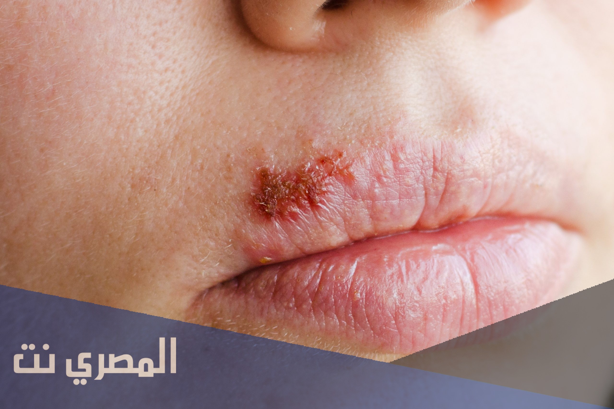 ما هو فيروس الهربس واعراضه