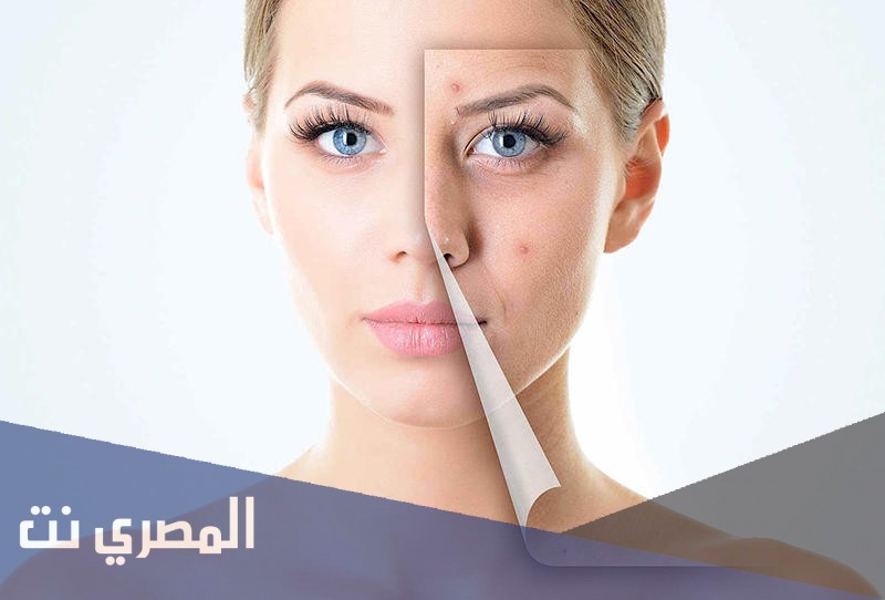 علاج حب الشباب