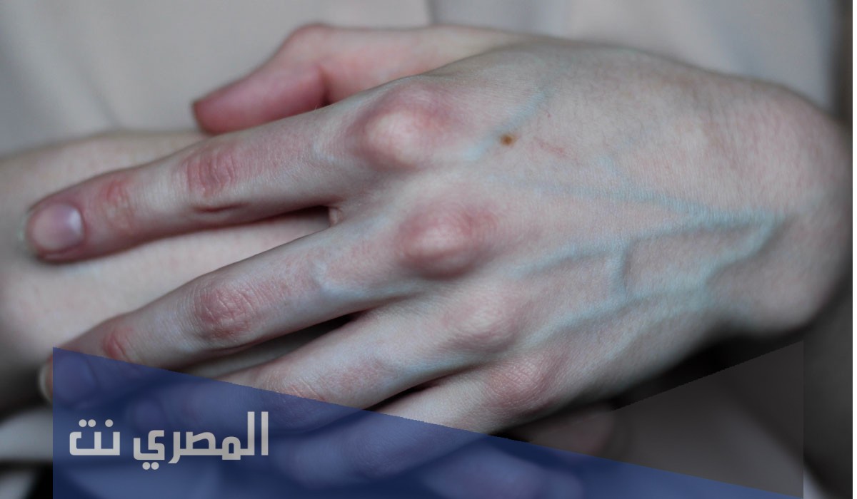أسباب بروز العروق وطرق علاجها