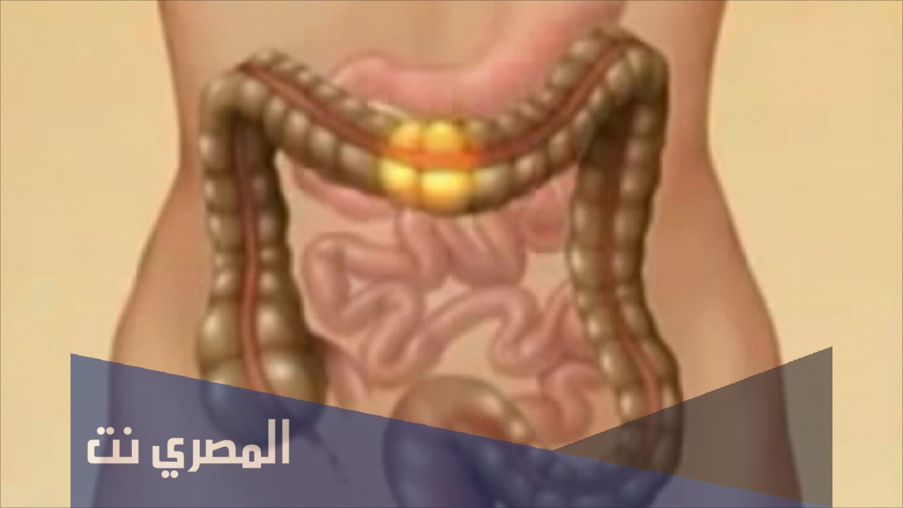 أسباب كثرة الغازات في القولون