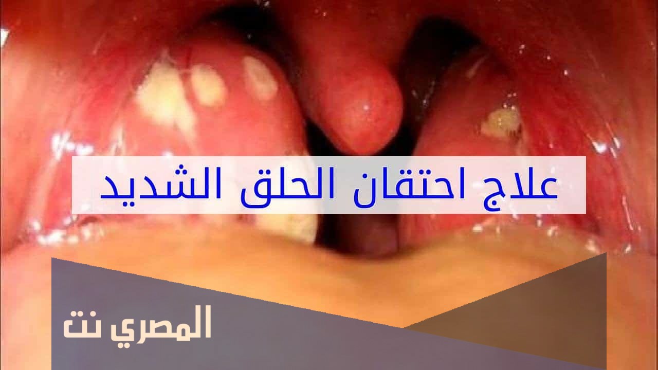أسماء أدوية احتقان الزور