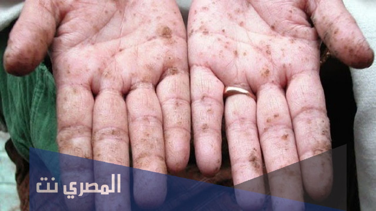 أعراض التسمم بالزرنيخ