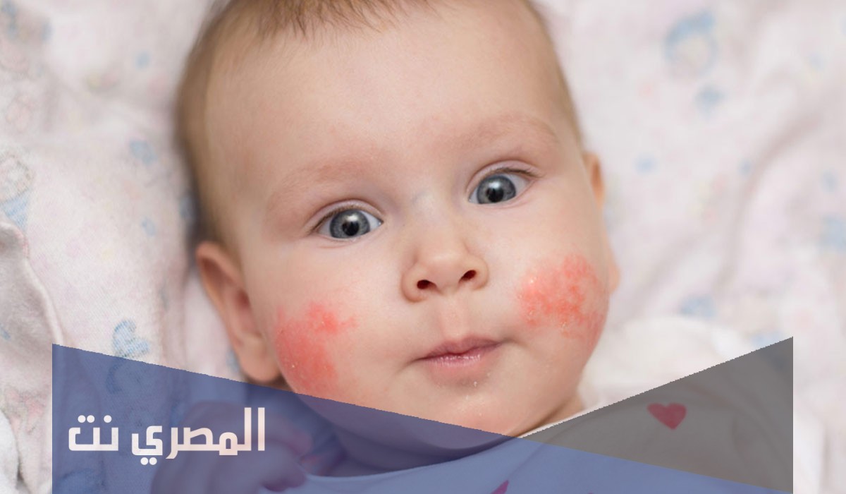 أعراض الحساسية للرضع
