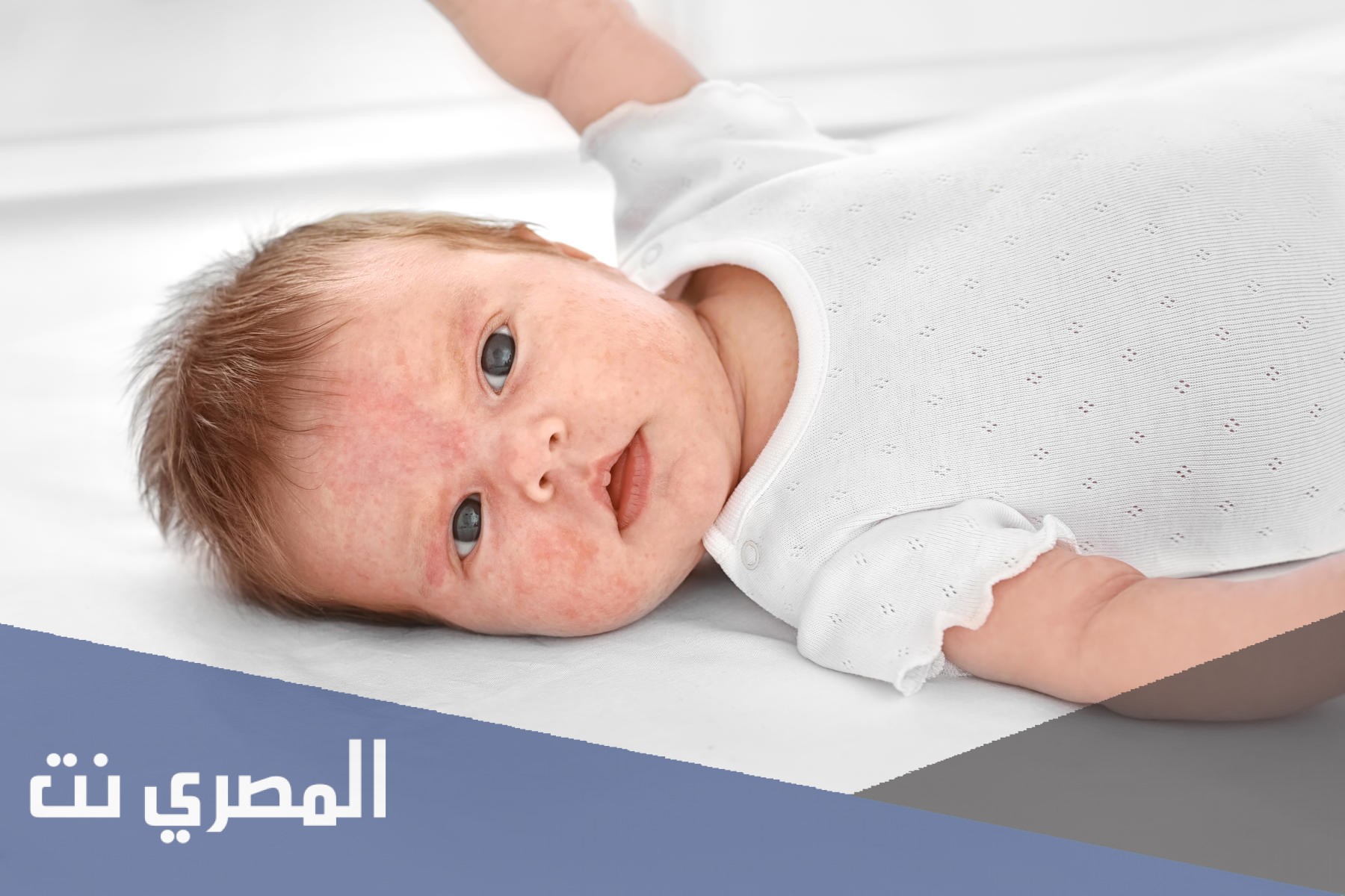 أعراض حساسية الشوكولاتة للأطفال
