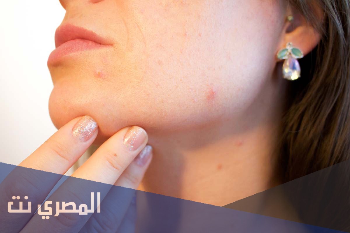 أعراض حساسية بروتين الحليب
