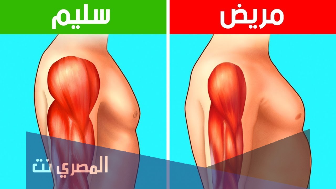 أعراض ضعف الأعصاب والعضلات