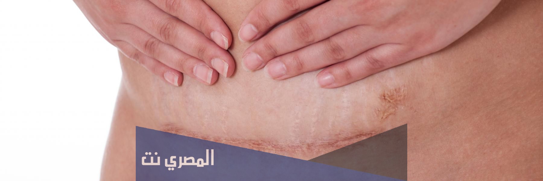 أعراض ما بعد العملية القيصرية